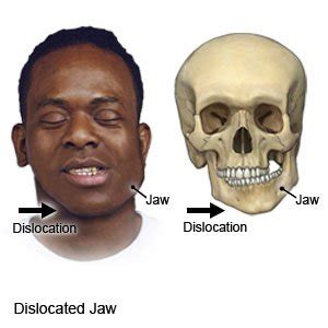 Jaw Dislocation - What You Need to Know