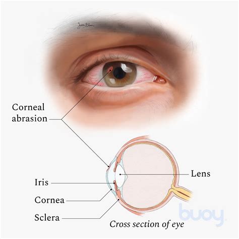 Eye Cornea Damage Symptoms - Infoupdate.org