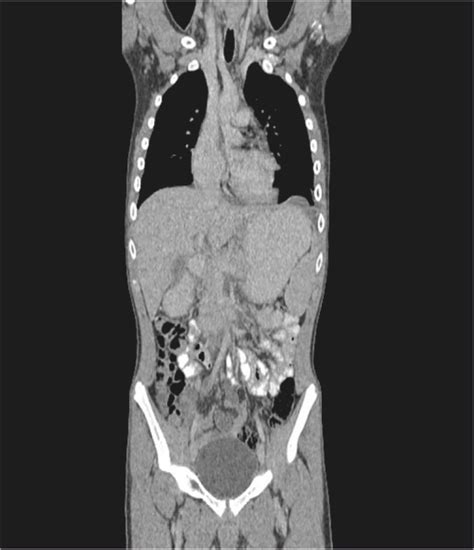 Ct Thorax Abdomen Pelvis With Contrast