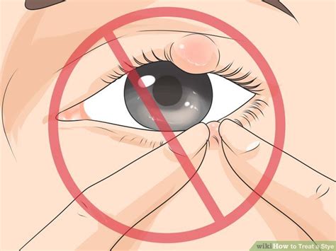 Stye Prevention and Remedies – Eye Stye Treatment | Diethics.com