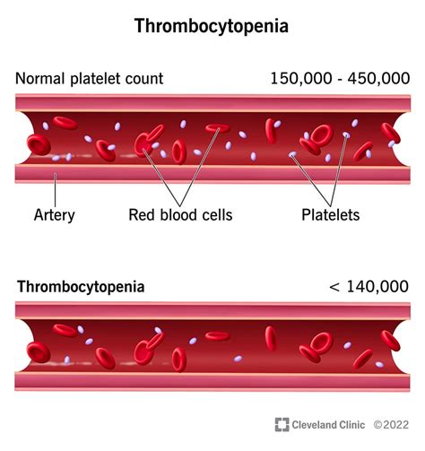 Thrombocytopenia: Symptoms, Stages & Treatment