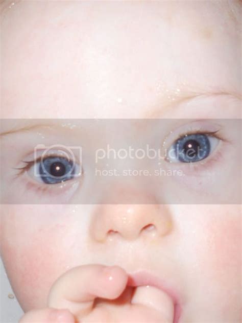 Brushfield Spots Pictures? - Page 5 - BabyCenter