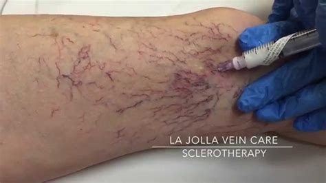 Clearing the Webs: Understanding Sclerotherapy Spider Vein Injections ...