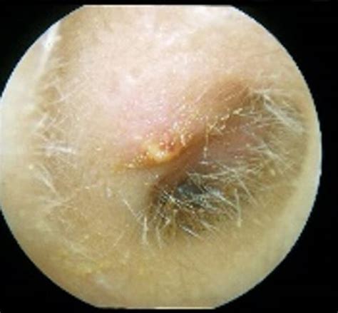 Otitis Externa (External Ear Infections, Swimmers Ear) - Sydney ENT Clinic