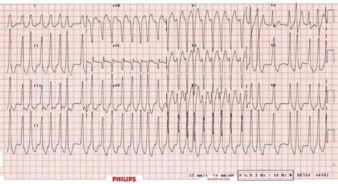 Who’s Afraid Of The Big Bad Wolff? • LITFL • Cardiology Clinical Case