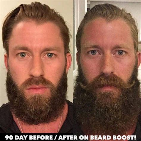 Beard Growth Supplement Before And After