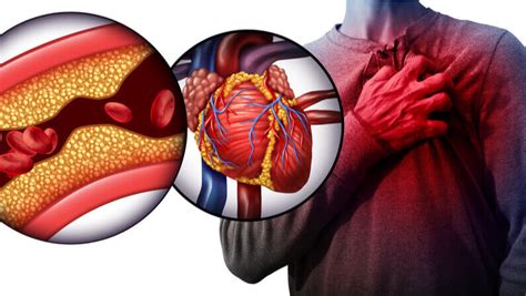 What Is A Blood Clot: Causes, Symptoms, And Treatment