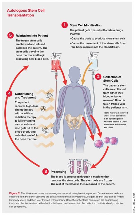 Stem Cell Transplantation | Autologous Stem Cell Transplantation | LLS