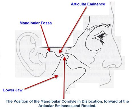 Jaw Dislocation – Exodontia