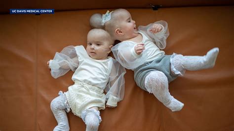 Conjoined twins successfully separated at the head in 24-hour operation