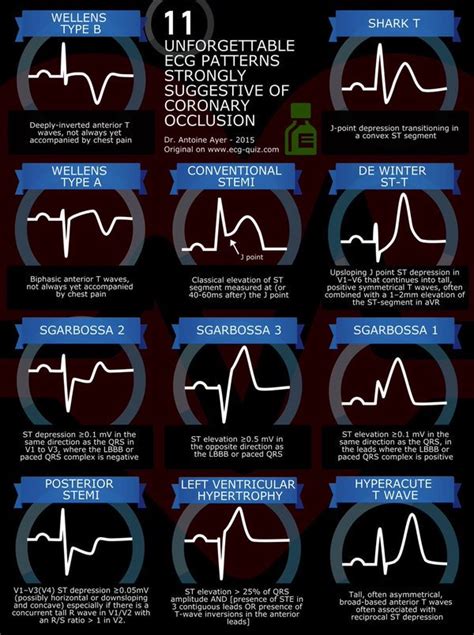 11 Heart Attack ECG Patterns - Emergency Medicine Kenya Foundation