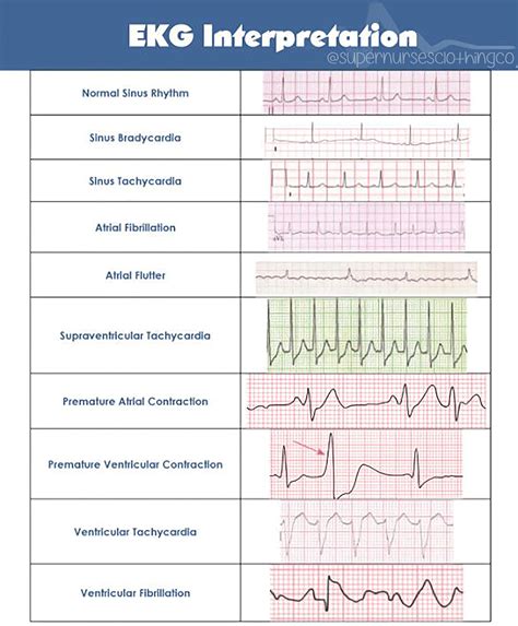 รายการ 97+ ภาพ Ekg 1 ช่องเล็ก คมชัด