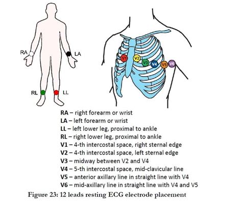 12 Lead Ecg Limb Electrode Placement