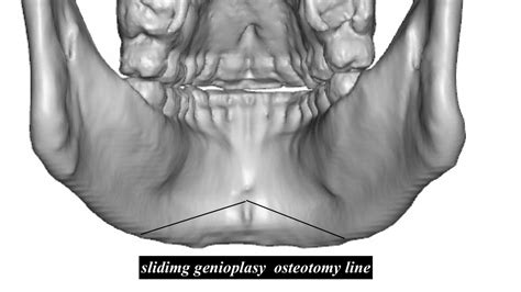 The Differing Effects of A Sliding Genioplasty vs Chin Implant On The ...