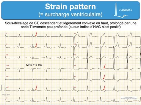 Strain pattern : e-cardiogram