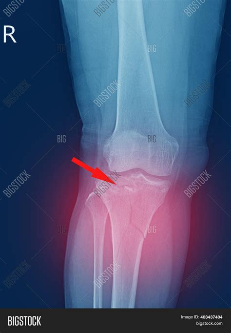 X-ray Knee Fracture Image & Photo (Free Trial) | Bigstock