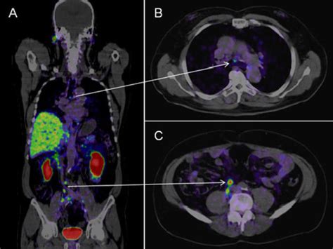 PSMA PET-CT Accurately Detects Prostate Cancer Spread - NCI