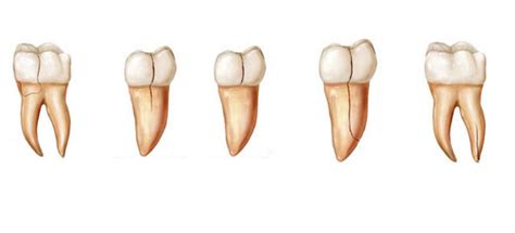 What is VRF (vertical root fracture) and cracked tooth syndrome? | News ...