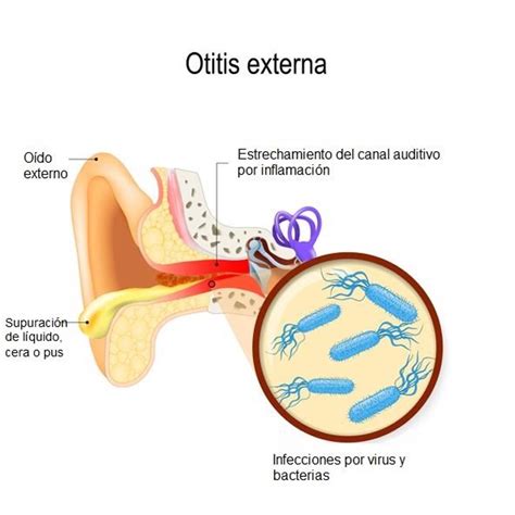 Dolor De Oido