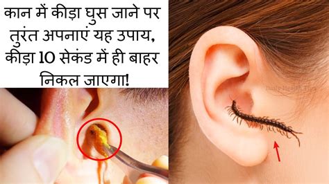 कान में कीड़ा घुस जाने पर तुरंत अपनाएं यह घरेलू उपाय | How To Remove ...