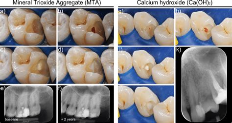 Representative photographs taken during partial pulpotomy procedure ...