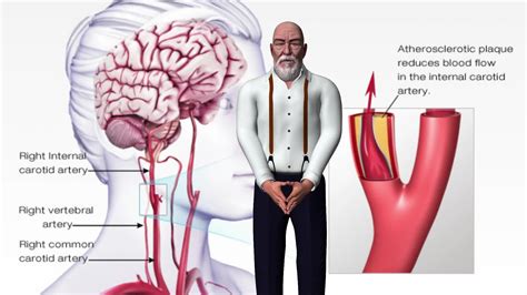 Symptoms Of A Mini Stroke | mens health clinic near me | men's health