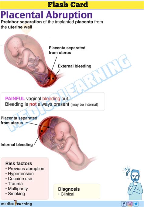 Placental Abruption – MedicoLearning