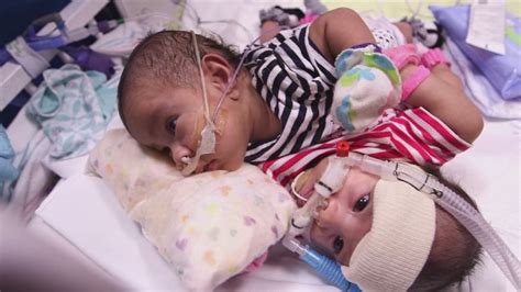 Conjoined twins take big step towards separation sugery - ABC13 Houston