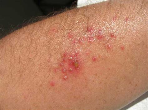 bacterial infection on skin - pictures, photos