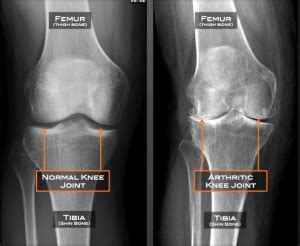 Knee arthritis compared to a normal knee x-ray - The Chiropractic ...