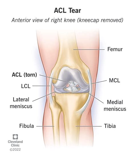 ACL Tear & Injury: Symptoms & Recovery