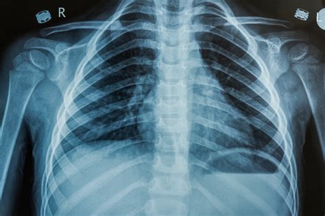 What Can an Xray Tell You About Your Bones?