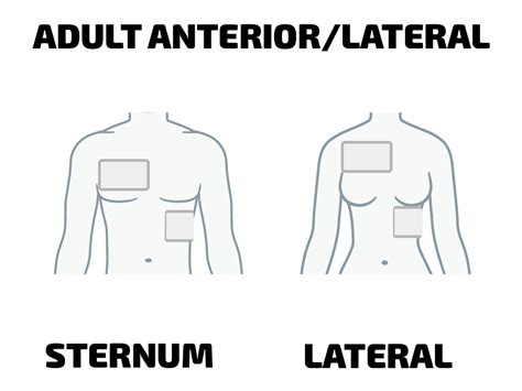 AED Pad Placement FAQ | Heartsmart