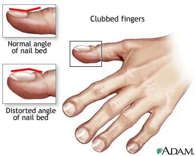 This is one of the common symptoms of CF, clubbed fingers. I do have it ...