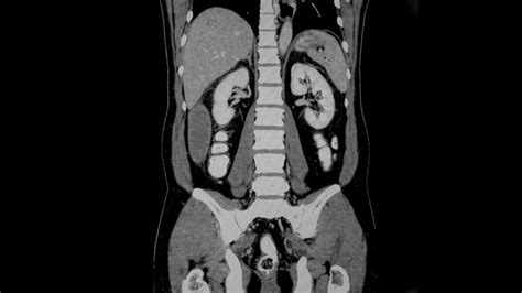 Normal Ct Scan Abdomen