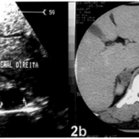 Abdominal US (2a) and CT scan (2b) of the right adrenal gland ...