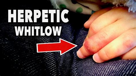 Herpetic Whitlow: Learn It Like the Back of Your Hand | Healthtian