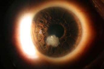 Corneal Ulcers | Mid Atlantic Cornea Consultants