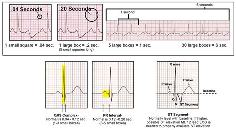 How to read and interpret an ECG/EKG - ACLS Wiki