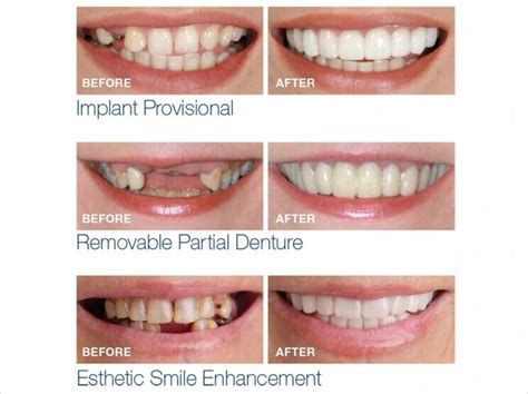 Snap On Smile & Dentures | Eyes & Smiles - Expert 5* Dentist in Friern ...