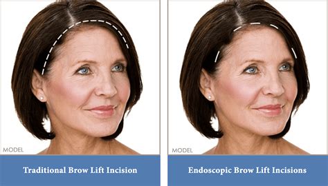 Brow (Forehead) Lift Washington, DC, & Arlington, VA | Potomac Plastic ...