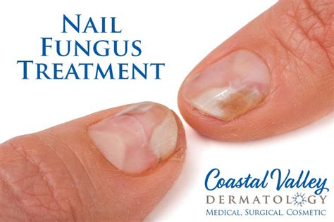 Nail Fungus - Coastal Valley Dermatology