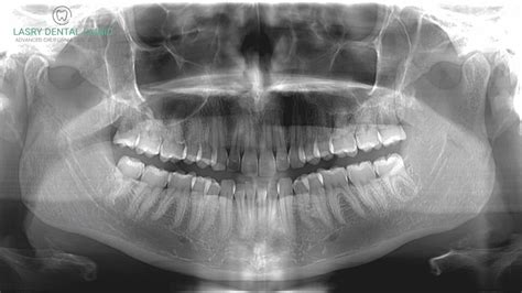 Cone Beam X Ray Dental Code - The Best Picture Of Beam