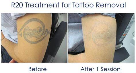 How Laser Tattoo Removal Works - Schweiger Dermatology | Book Now