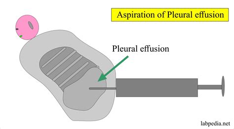 Fluid Analysis – part 6 – Pleural Fluid Analysis, Aspiration procedure ...