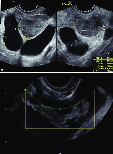 Fallopian tube on ultrasound identified because of (a) Fluid in the ...