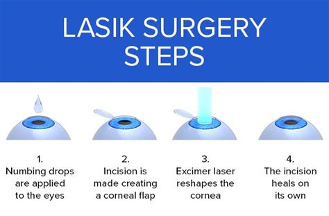 LASIK Laser Eye Surgery - Smart Laser Eye Center