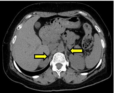 Adrenal atrophy CT - wikidoc