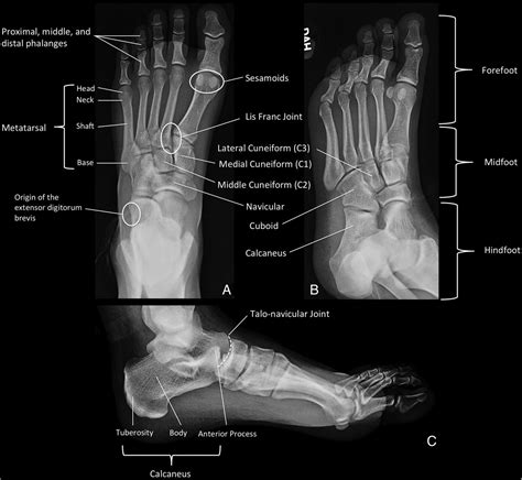 Osseous injuries of the foot: an imaging review. Part 1: the forefoot ...