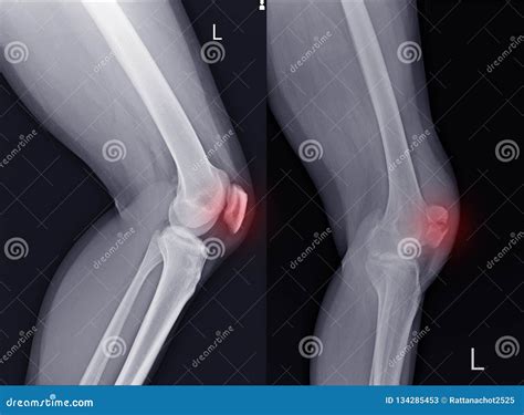 X-ray Left Knee Lateral Showing Kneecap Fracture And Post Operation ...